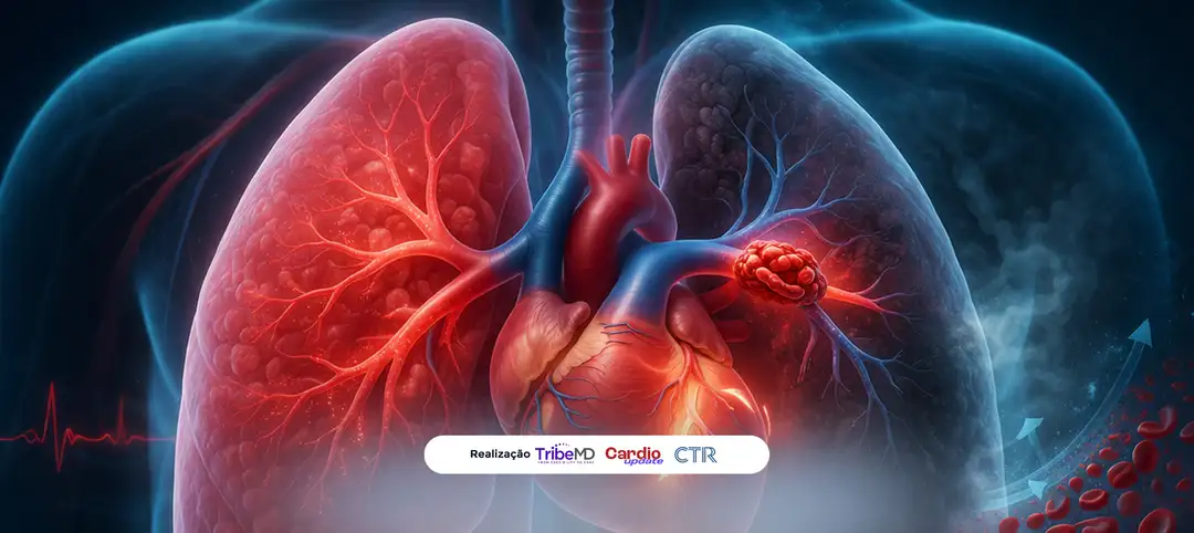 ACC 2026 – HI-PEITHO: trombólise dirigida por cateter reduz descompensação em TEP de risco intermediário